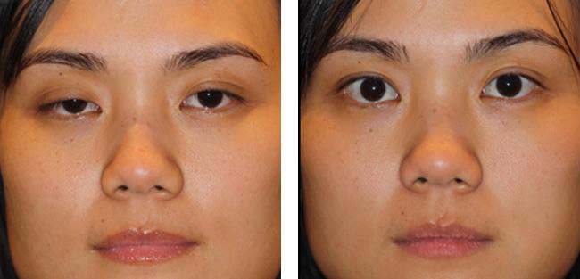 Oculoplasty Surgery in Pune