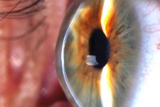  keratoconus-treatment