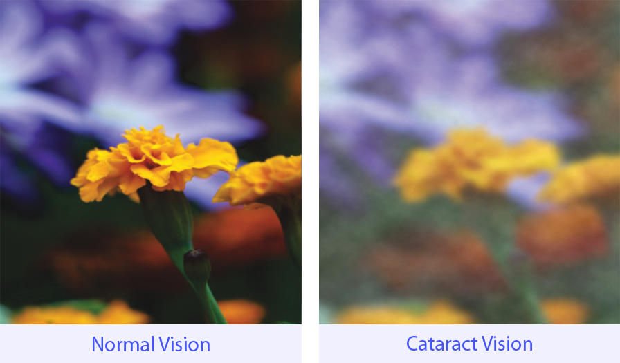 Normal and Cataract vision