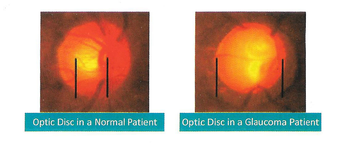 Optic Disc in a Normal Patient and optic Disc in a Glaucoma Patient