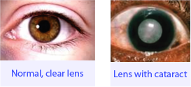 Normal clear lens