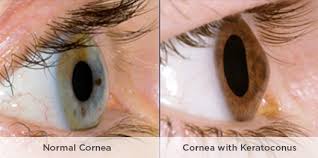 normal cornea and cornea with keratoconus