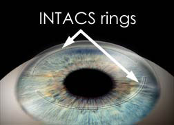 Intacs Surgery for Keratoconus